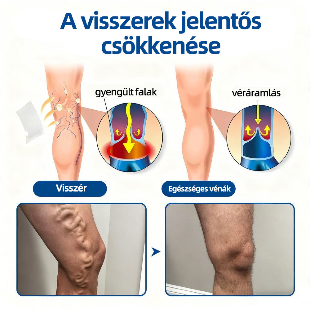 Healrize® Vénacélpont mikrotűs tapasz⚡Azonnali enyhülés hosszú távú eredmények🇭🇺